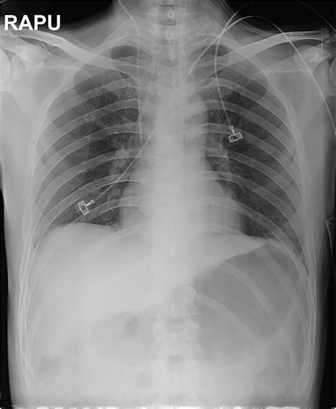Distended Stomach In Diabetic Coma X Ray Hactw