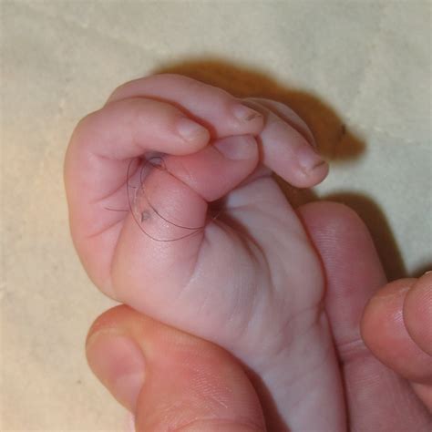 She had a hair tourniquet around her. Can long hair hurt your baby - The Bumpkin Button