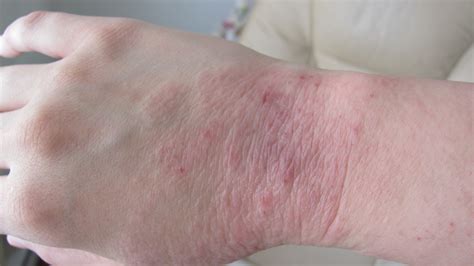 Dry Patches On Hands Pictures Photos