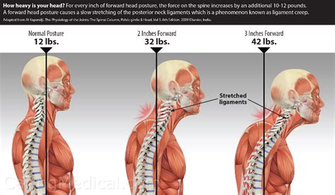 Forward Head Posture Can Create Problems Such As Headaches Neck