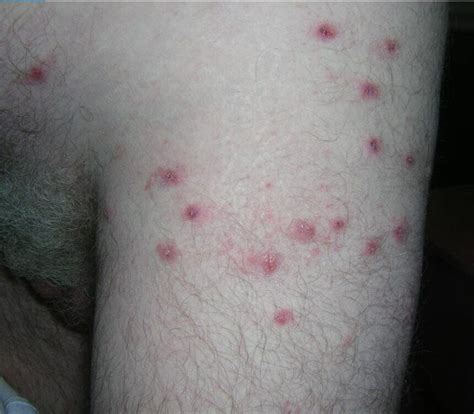 Clinical Challenge Itchy Rash On Shoulders Trunk Mpr