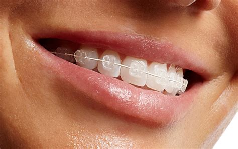 Benefits Of Invisalign Clear Braces Globalsistergoods