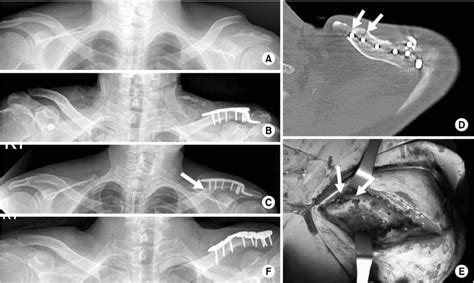 A Neer Type Iia Distal Clavicle Fracture B Open Reduction And
