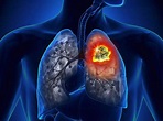 8 triệu chứng ung thư phổi giai đoạn cuối