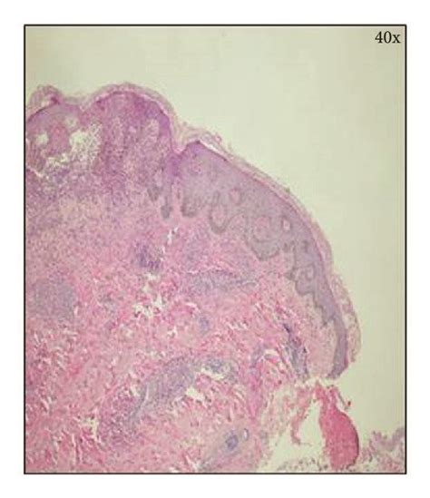 Clinical Picture Of The Bullous Lesion Along With Histopathologic