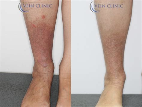 Venous Eczema Case Study Before And After Vein Clinic Perth