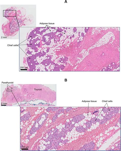 Histology A Parathyroid B Lipomatous Parathyroid Tissue With Discrete