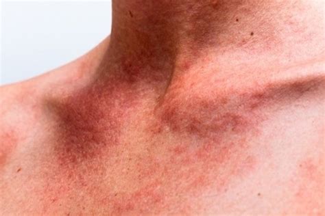 Urticaria colinérgica qué es síntomas y tratamiento con fotos Tua