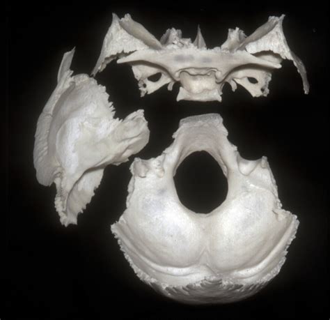 Superior View Of Disarticulated Sphenoid Temporal And Occipital Bones