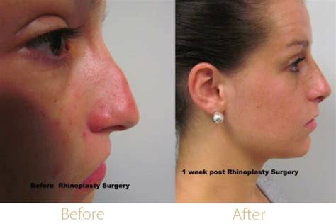 Nasal Reconstruction Rhinoplasty Dr Anthony Farole Dmd Facial And