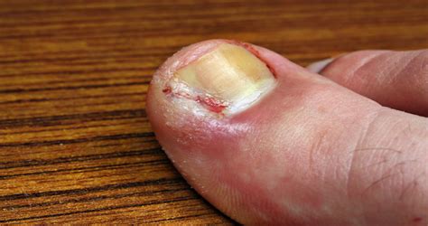 Ingrown Toenail Foot Healthcare Associates