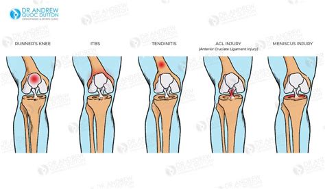 Arthroscopy Or Keyhole Surgery For Acl And Meniscal Injuries Dr Dutton