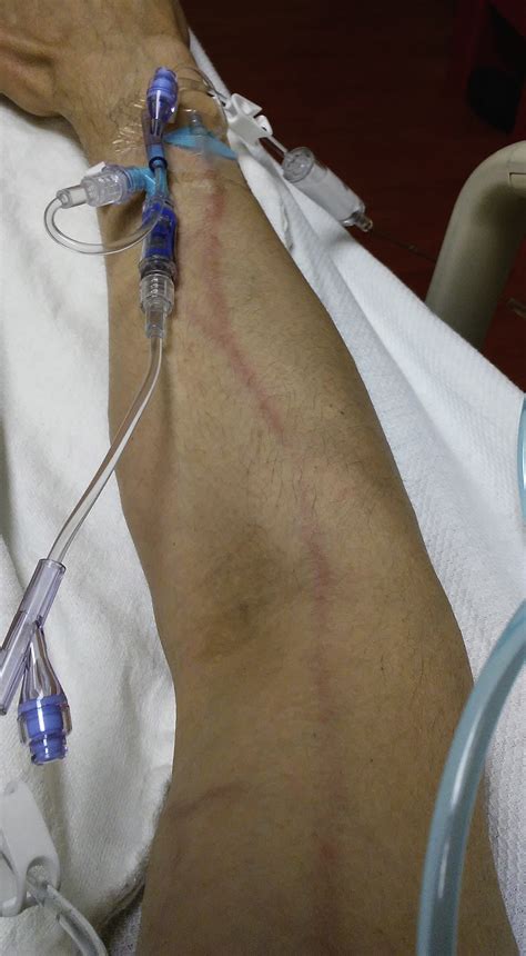 Superficial Thrombophlebitis From Intravenous Pentamidine In