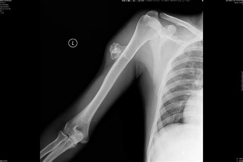 Pedunculated Exostosis Of Right Humerus Radrounds Radiology Network