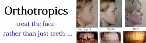 Orthotropics Orthodontic Treat Face And Align Teeth22 Orthotropics