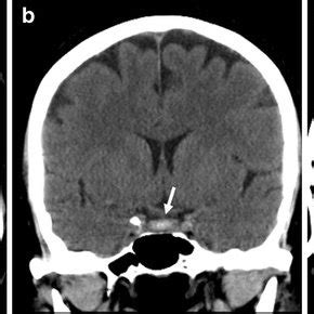 Ct Appearance Of Pituitary Apoplexy Arrows On Axial A Coronal B My