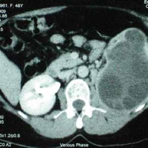 A Computed Tomography Scan Showing A Large Hydatid Cyst Of The Left