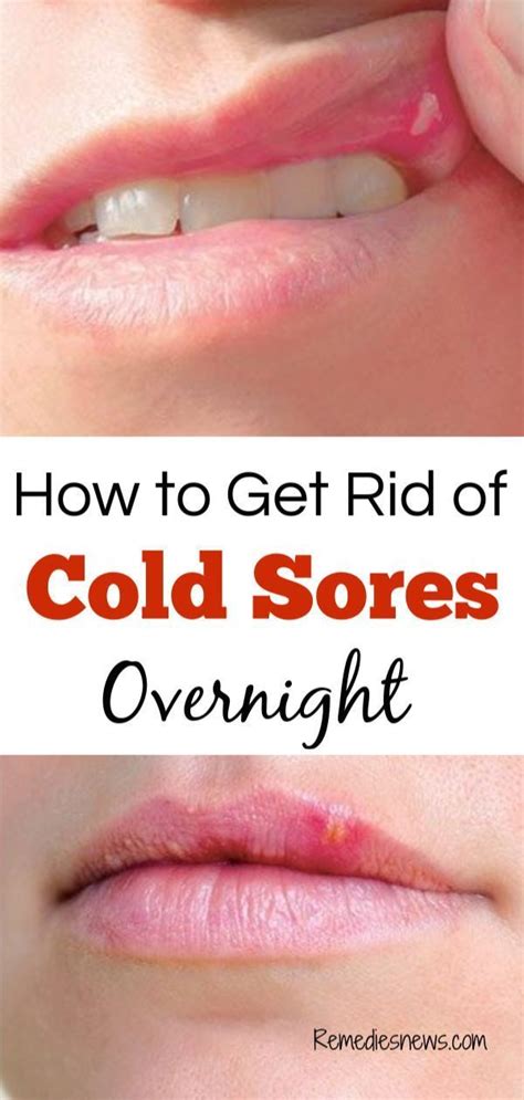 How To Get Rid Of Cold Sores Fast 11 Best Home Remedies Cold Sores