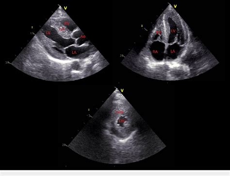 Echocardiogram Echocardiogram Showing Left Ventricular Hypertrophy And