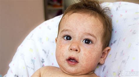 Can Breast Milk Wipe Face Treat Eczema Asian Home Doctor