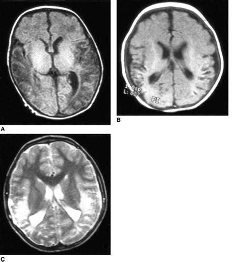 Hypoxic Ischemic Encephalopathy Correlation Of Serial Mri And Outcome