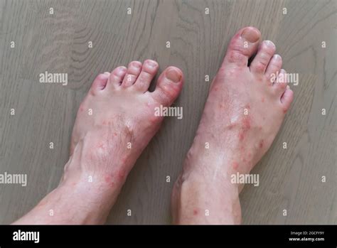 Close Up On Many Mosquito Bites On Mens Foot Skin Stock Photo Alamy