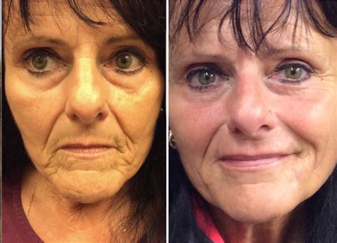 Liquid Face Lift Before And After Photos Lisa Bunin Md