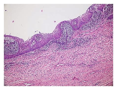 The Cyst Was Lined By Nonkeratinized Flat Stratified Squamous