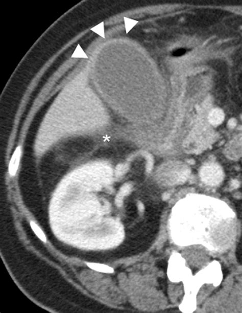 Diffuse Gallbladder Wall Thickening Differential Diagnosis Ajr