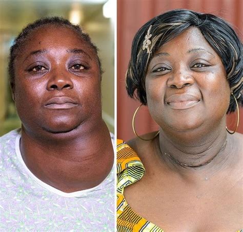 Womans Goiter Of 10 Years Removed Via Surgery Photos Health Nigeria