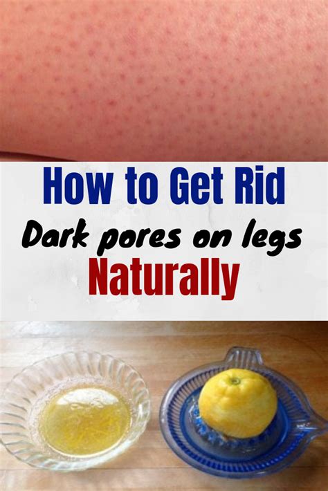 How To Get Rid Of Strawberry Legs Strawberry Legs Dark Pores Dark