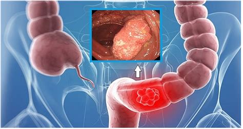 Rules to examine with a colon checker. I tumori del Colon-Retto - Casa di Cura Caminiti
