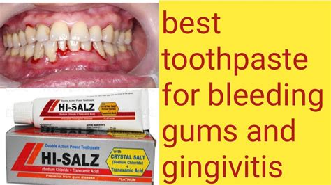 Best Toothpaste For Bleeding Gums And Gingivitis Hi Salz Toothpaste