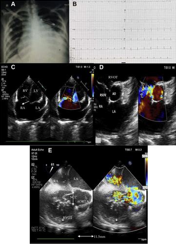 Acute Left Ventricular Systolic Dysfunction Following Device Closure Of
