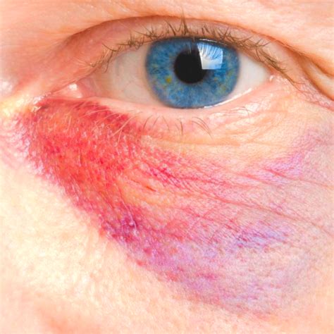 Black Eye Remedies Dark Circle Remedies How To Cover Bruises Cuts