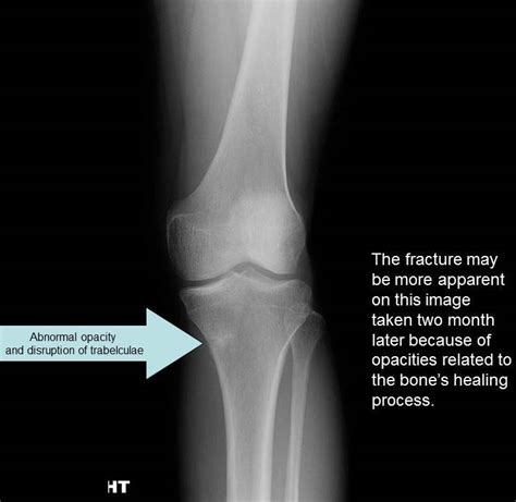 Radiography Knee Injury And Prevention