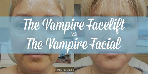 Vampire Facelift Vs Vampire Facial What S The Difference Beverly Hills Rn