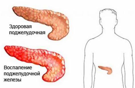 Что такое панкреатит диета