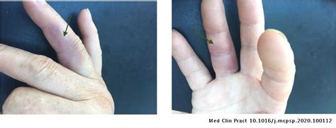 Paroxysmal Finger Haematoma A Case Of Achenbachs Syndrome Medicina