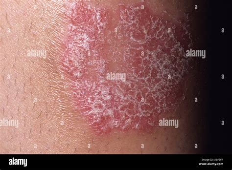 A Scaly Erythematous Lesion Typical Of Chronic Plaque Psoriasis Stock