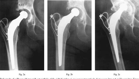 Figure 2 From Radiological Factors Influencing Femoral And Acetabular