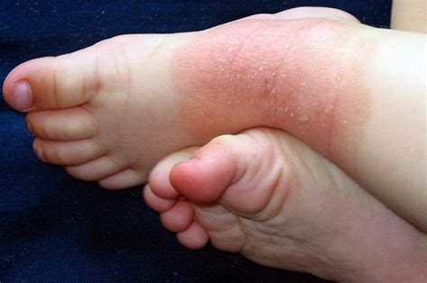 Dermatite Atopica Cos Quali Sono I Sintomi E Come Si Cura Questa Malattia Della Pelle