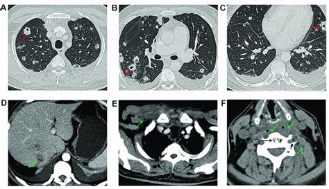 Enhanced Computerized Tomography Ct Of The Implicated Organs At