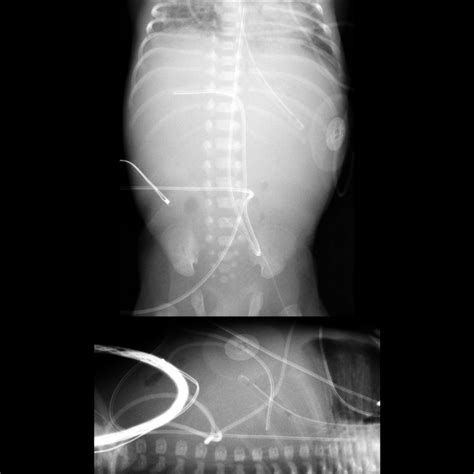 Umbilical Venous Catheter Malfunction Malposition Misposition