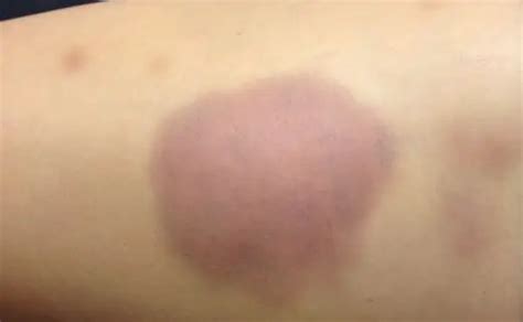 How To Treat Bruises Treat Bad Severe And Deep Bruises Ointment