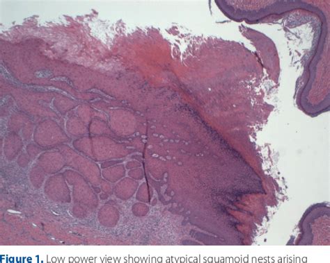 Figure 1 From A Squamous Cell Carcinoma Arising From Scrotal Epidermal