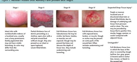 Pressure Ulcers Bed Sores Pressure Ulcer Bed Sores Ulcers Images