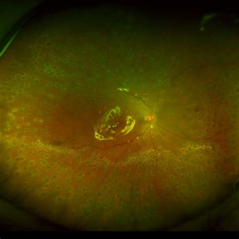 Wide Field Fundus Photography Of The Right Eye Postoperatively