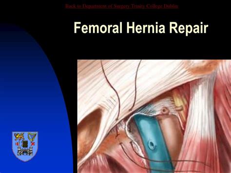 Diagram Diagram Of Femoral Hernia Mydiagramonline