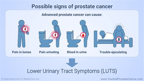 Slide Show Understanding Prostate Cancer